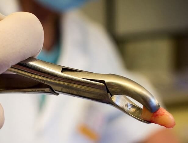 tooth extraction