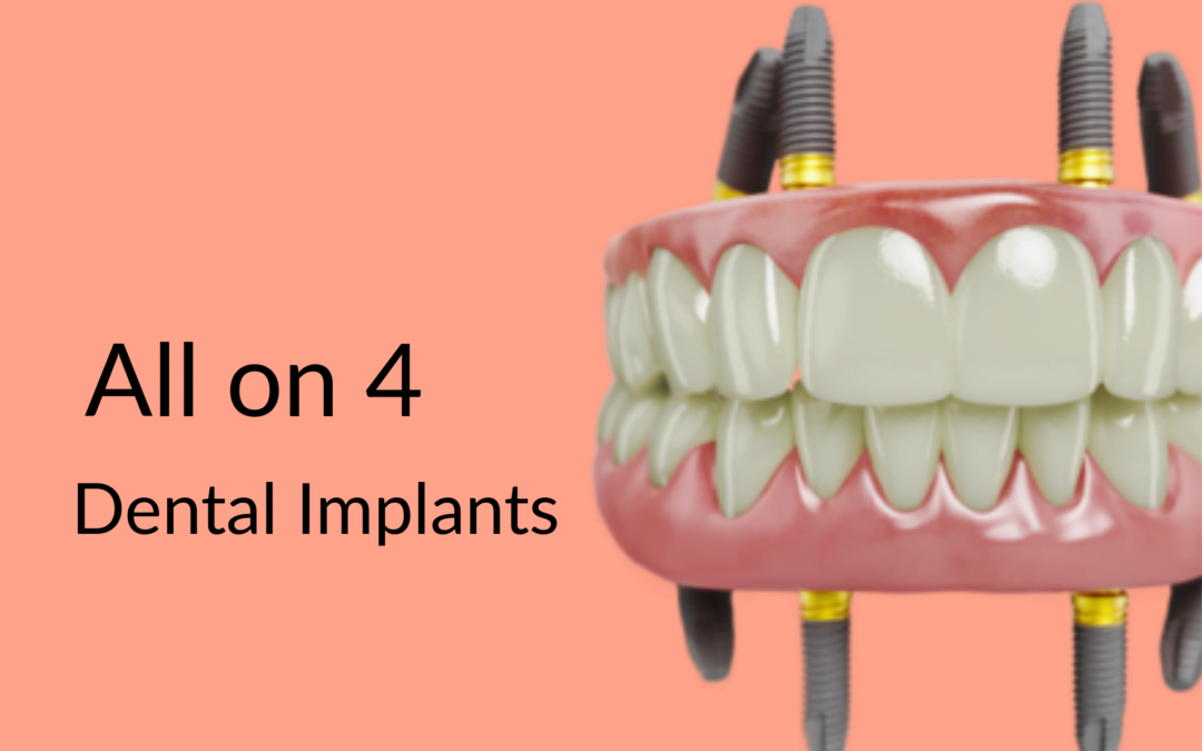 Special Dental Implant Offer Gurgaon