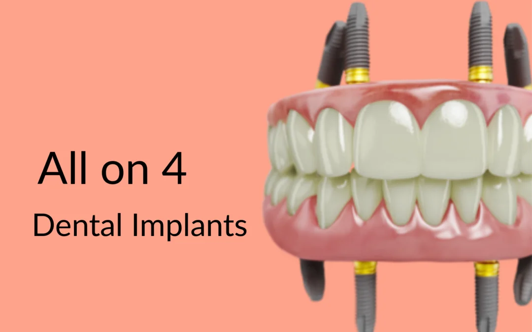 Special Dental Implant Offer Gurgaon