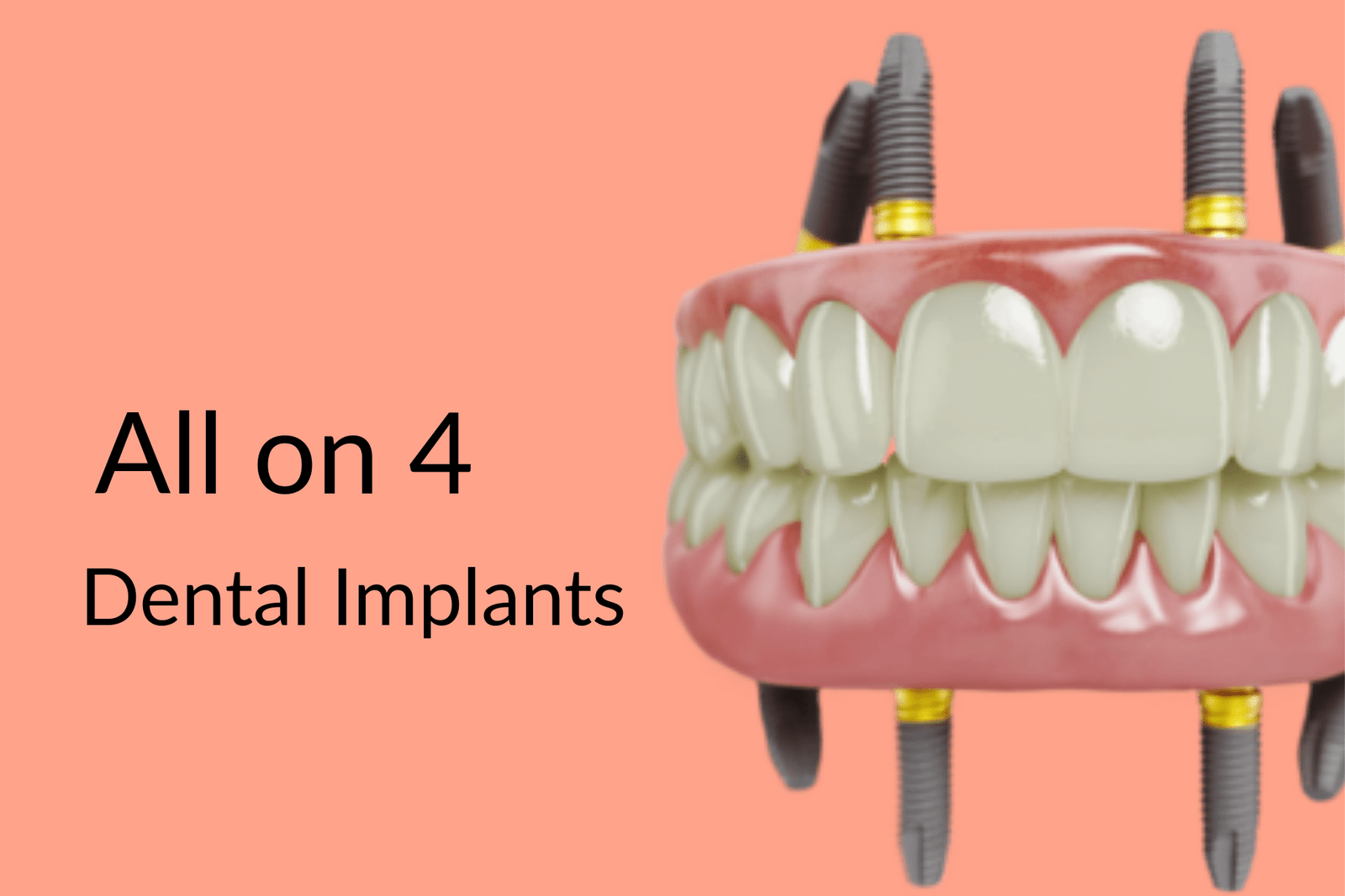 All on 4 dental implants in Gurgaon