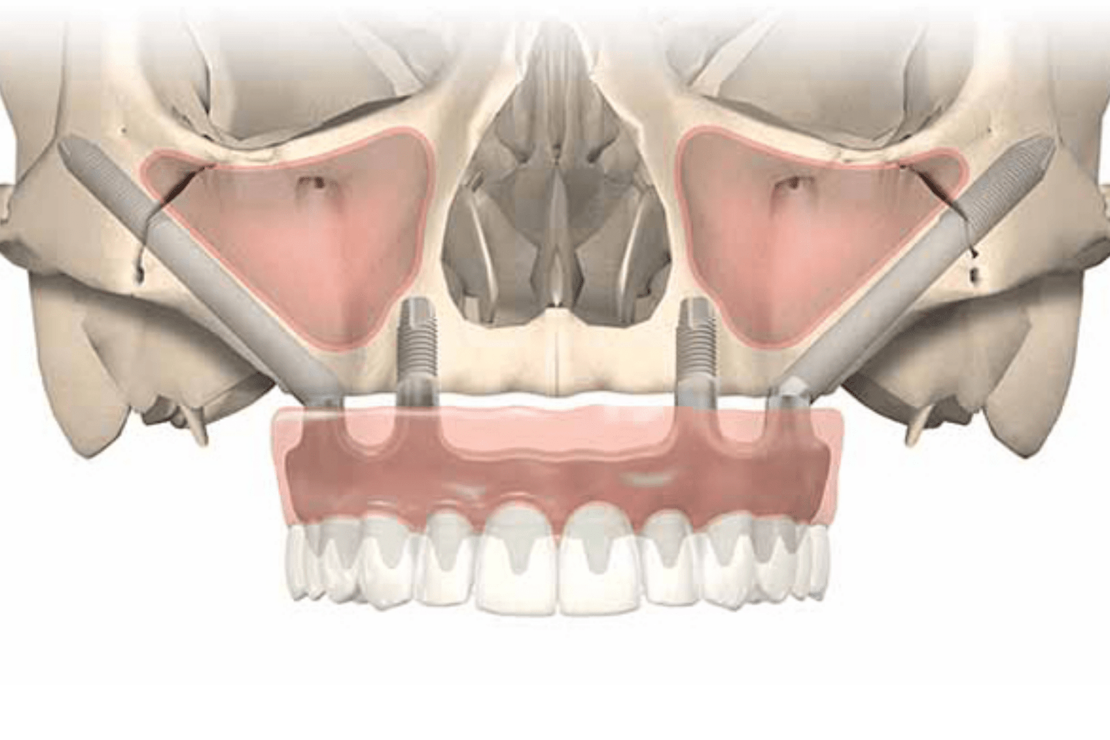 zygoma implants in Gurgaon