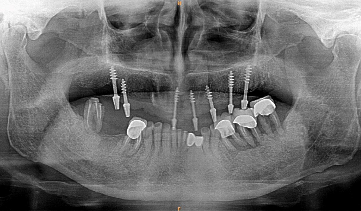 basal implant case