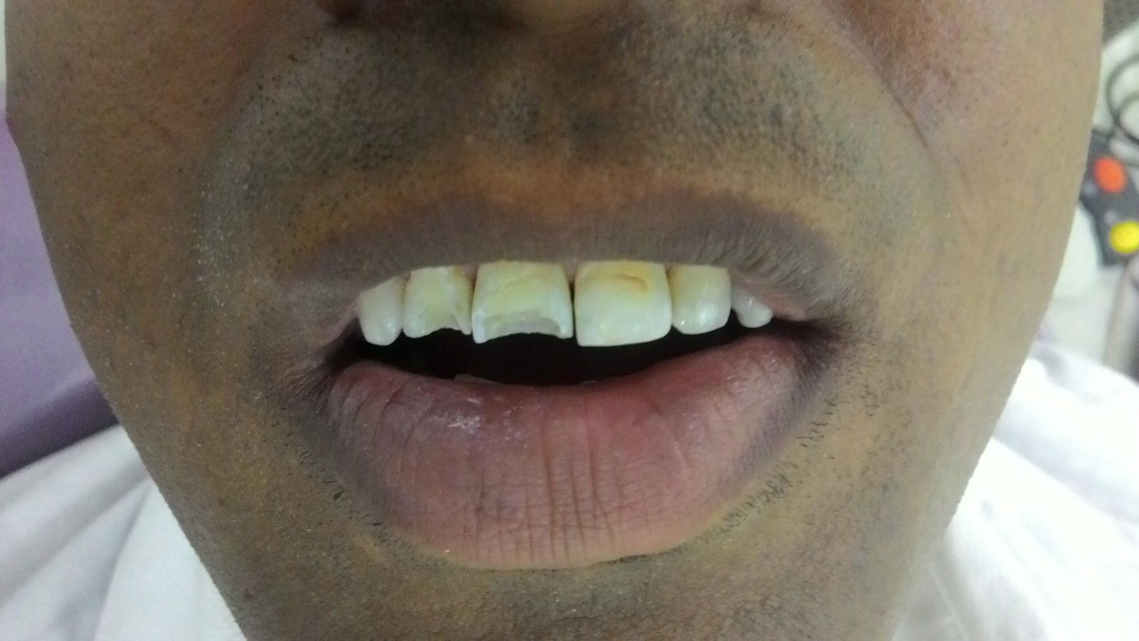 cosmetic-teeth-filling