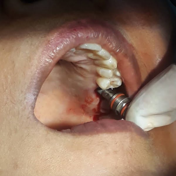 dental-implant-course