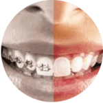 orthodontic-braces