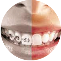 orthodontic-braces