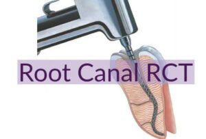 root-canal-treatment-gurgaon