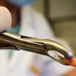 tooth-removal-surgery