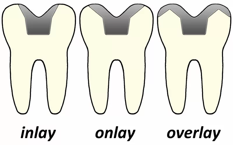 inlay-onlay-overlay