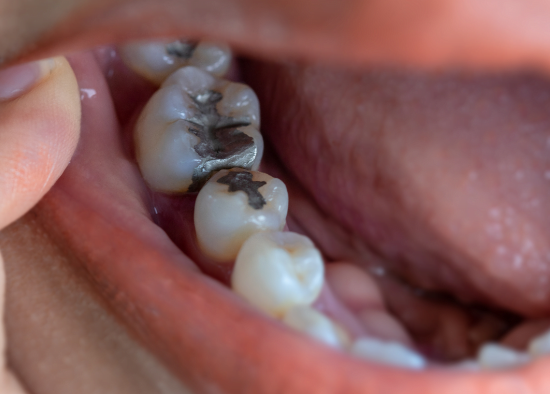 dental-cavity