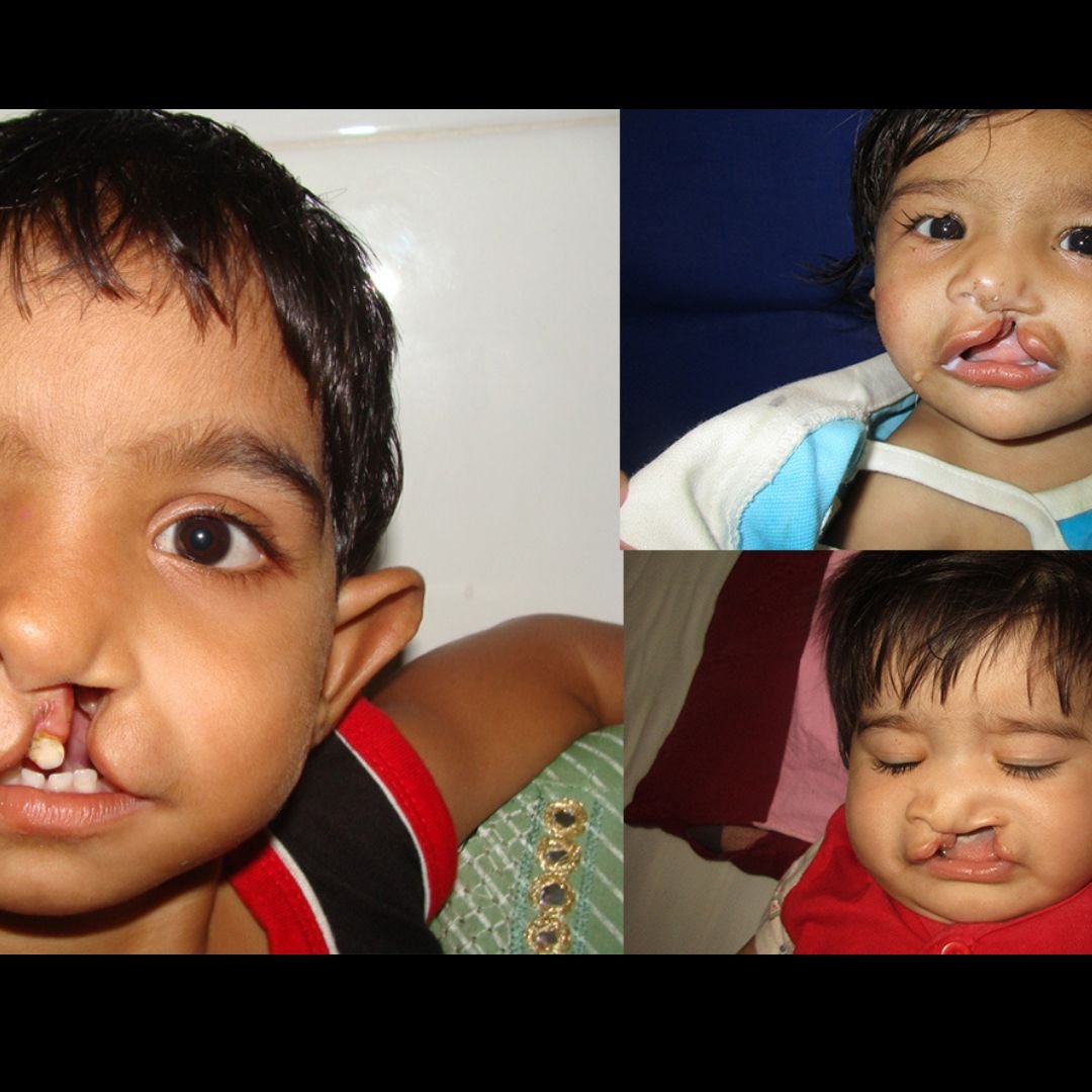 cleft lip palate
