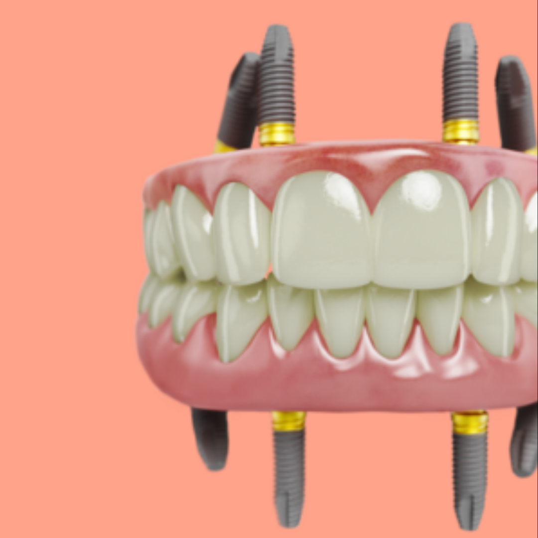 all-on-4-implants-Gurgaon