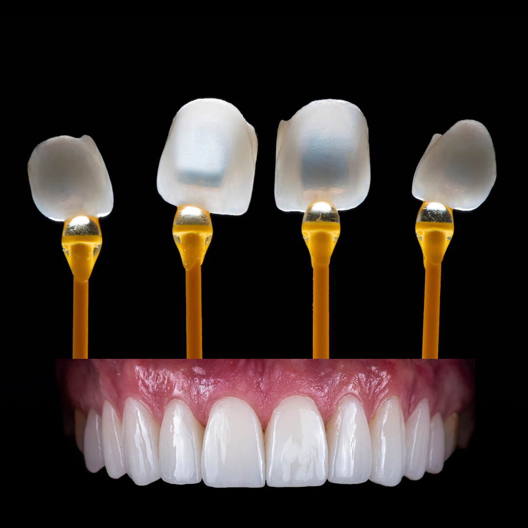 dental-veneers-Gurgaon