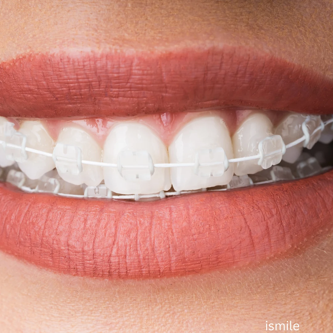 Best Ceramic Dental Braces in Gurgaon