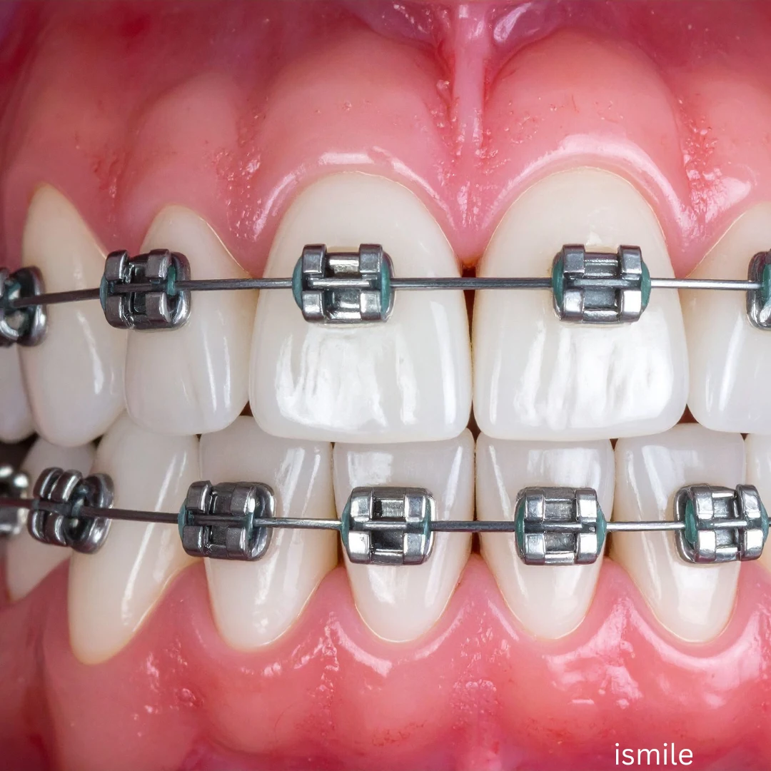 Best Metal Braces in Sec 40 Gurgaon