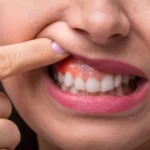 Gum infection treatment in sector 40 Gurgaon