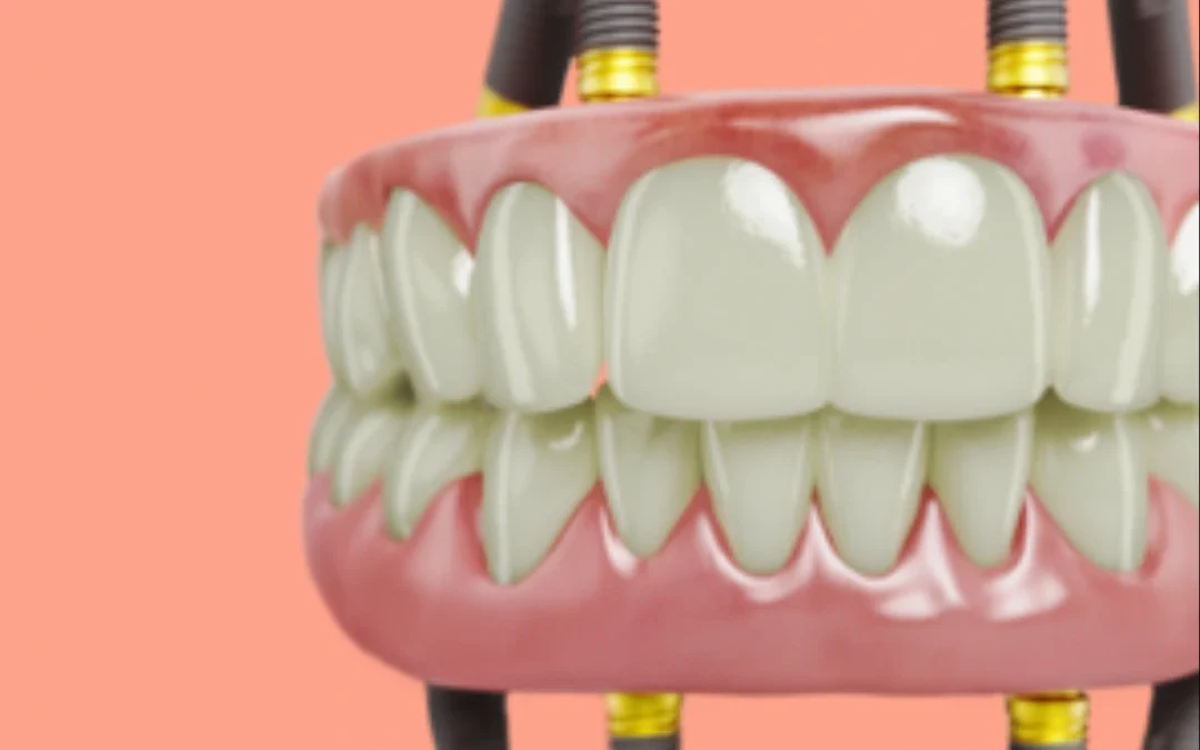 All-on-x dental implants in Sector 40, Gurgaon