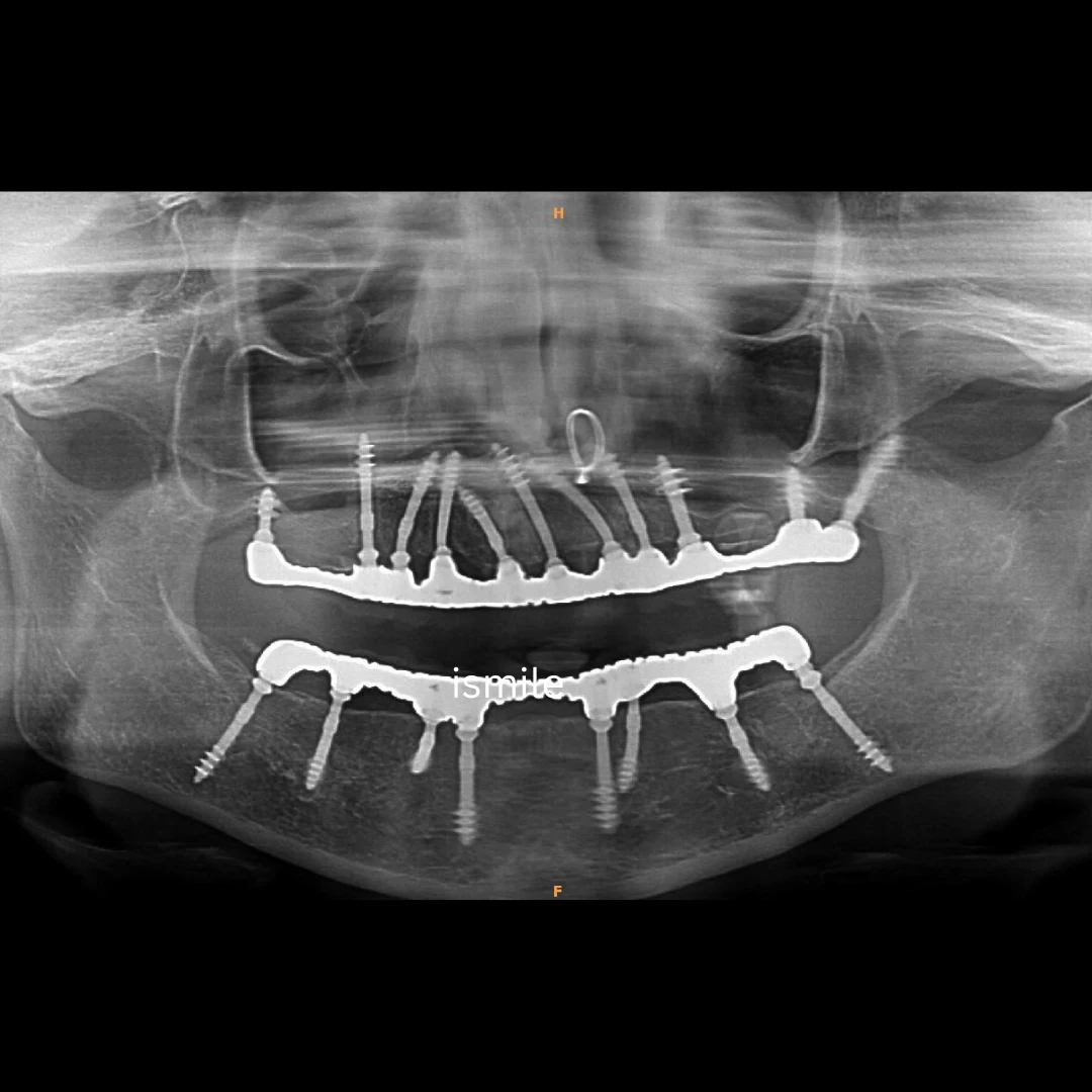 cortical dental implants in sector 40 Gurgaon