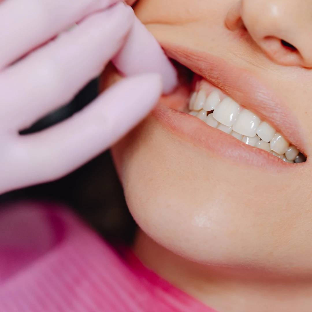 cosmetic-dental-filling-in-Gurgaon