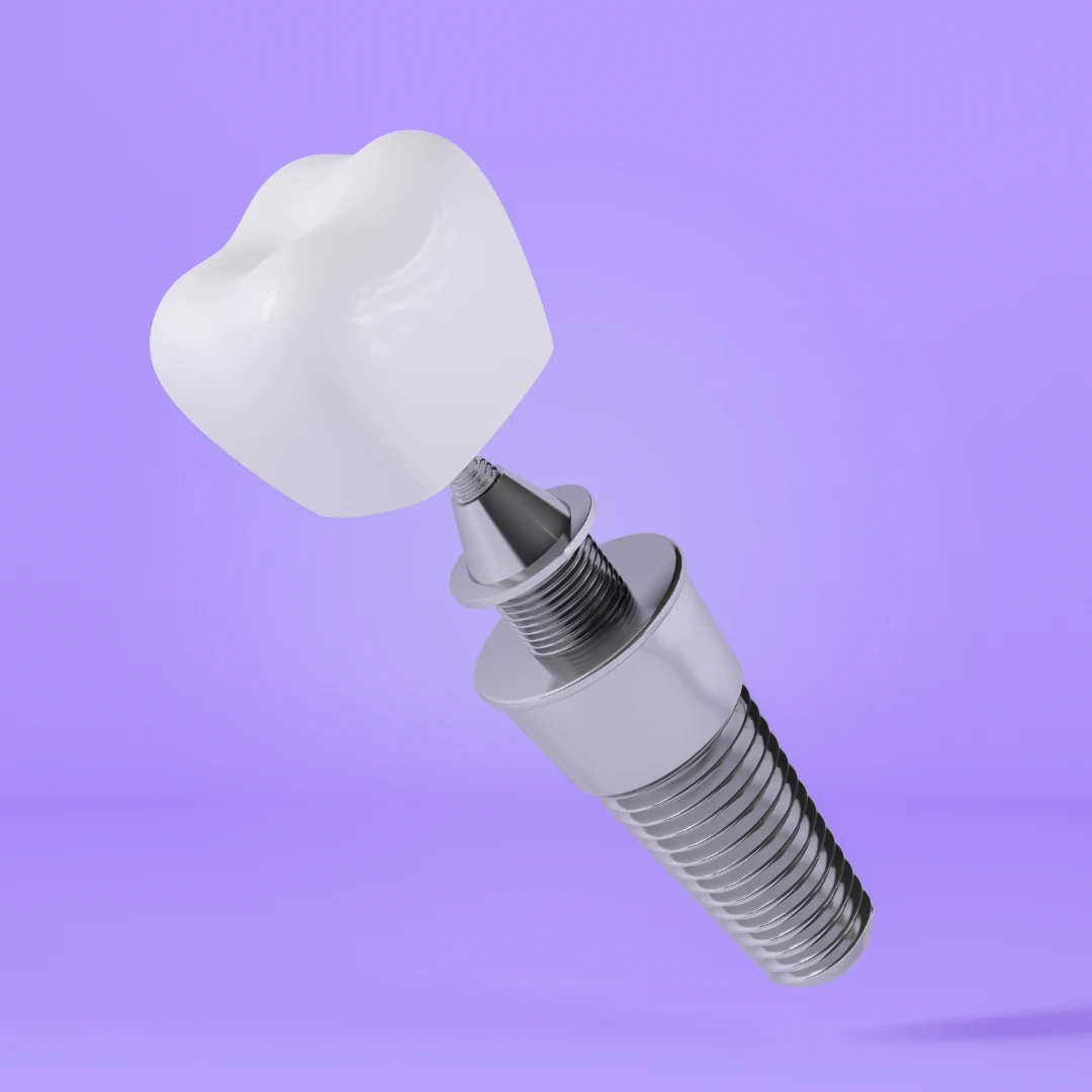 Best-dental-implants-in-Gurgaon