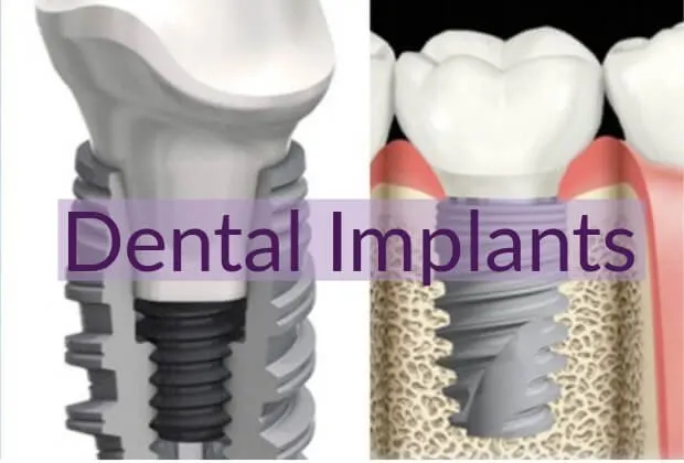 dental implants in sector 40 Gurgaon