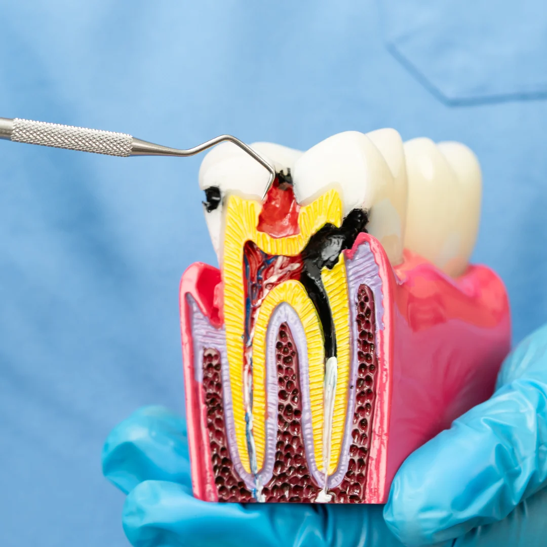 painless-RCT-in-Gurgaon