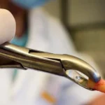 tooth-removal-in-Gurgaon