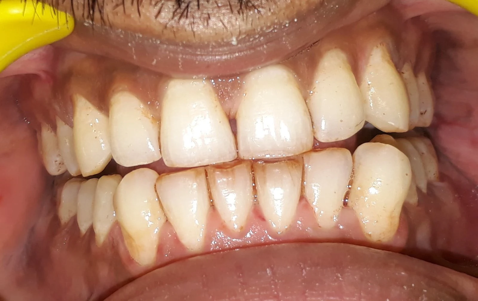 teeth cleaning and polishing in Gurgaon After