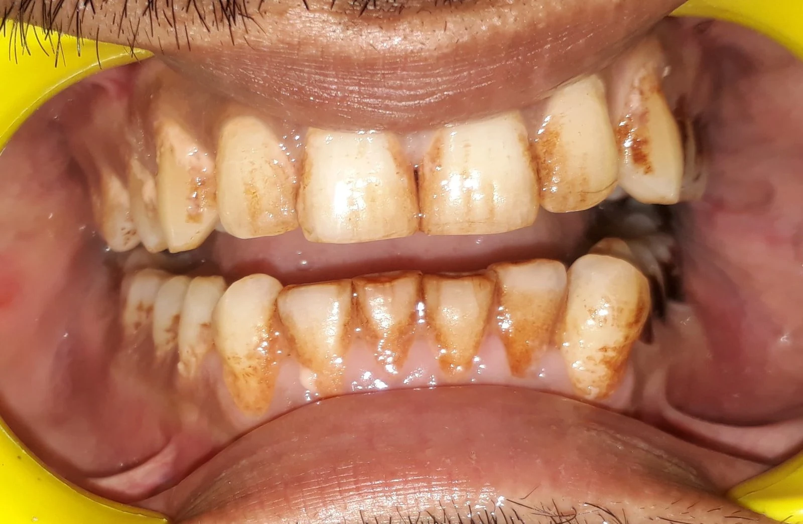 teeth cleaning and polishing in Gurgaon Before