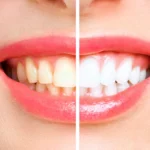 professional teeth whitening in Gurgaon