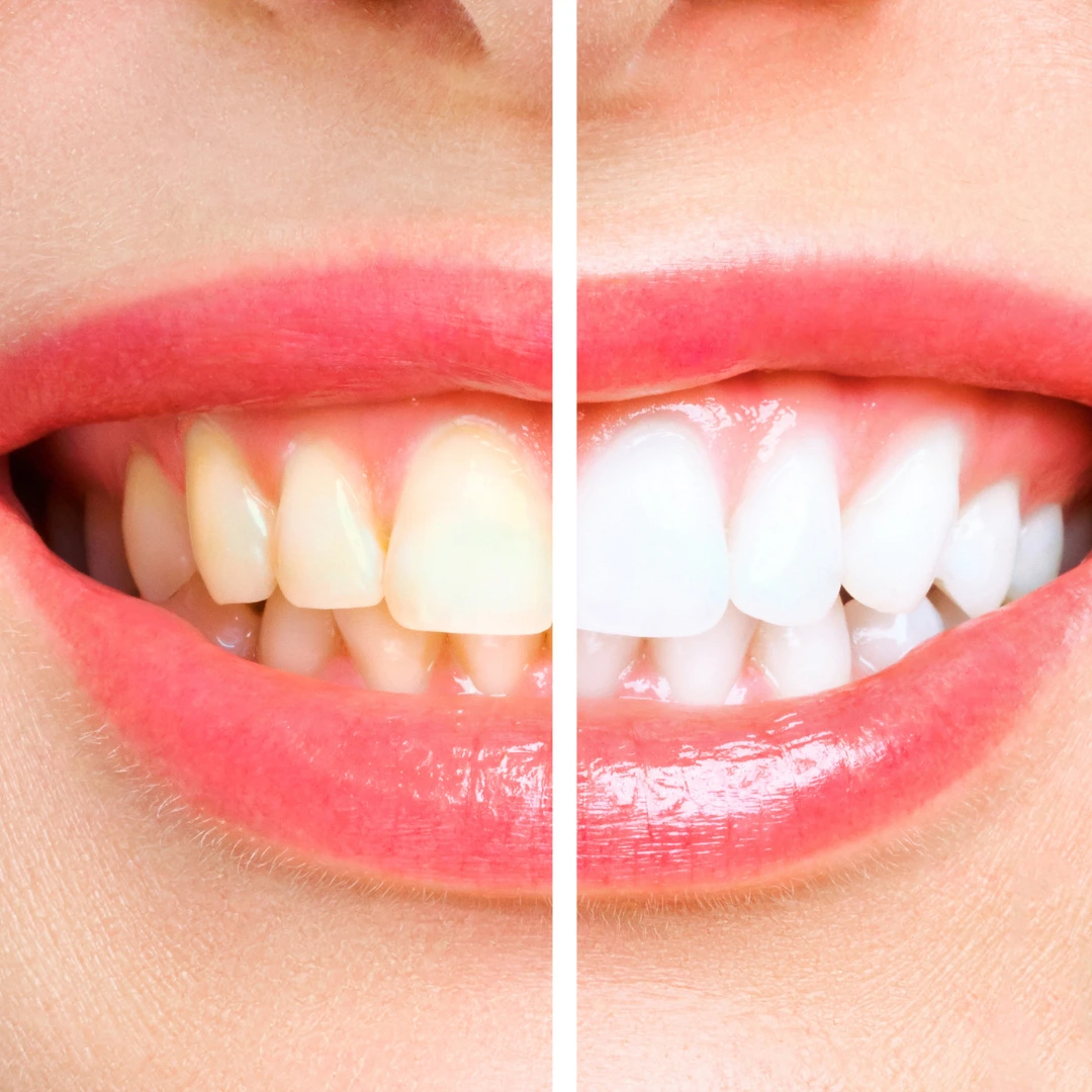 teeth-whitening-Gurgaon