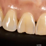 tooth-discoloration-in-Gurgaon