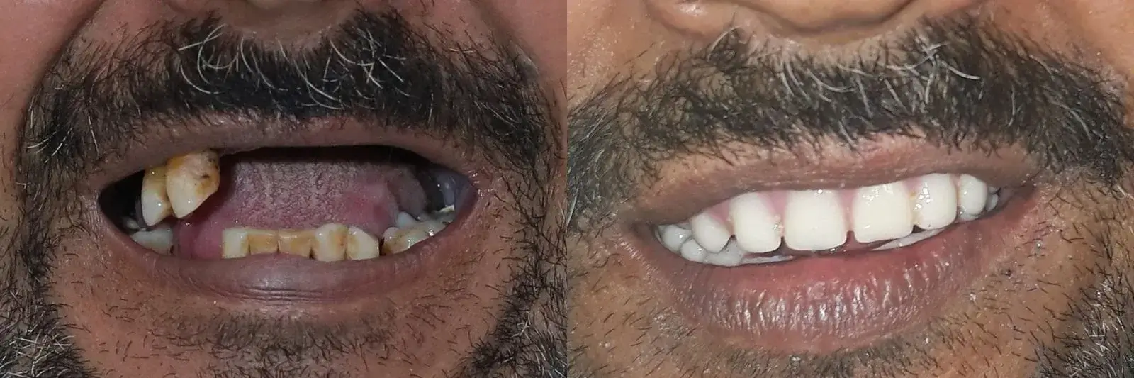 Before-after-full-mouth-implants-in-Gurgaon full mouth dental implants in Sector 40, Gurgaon