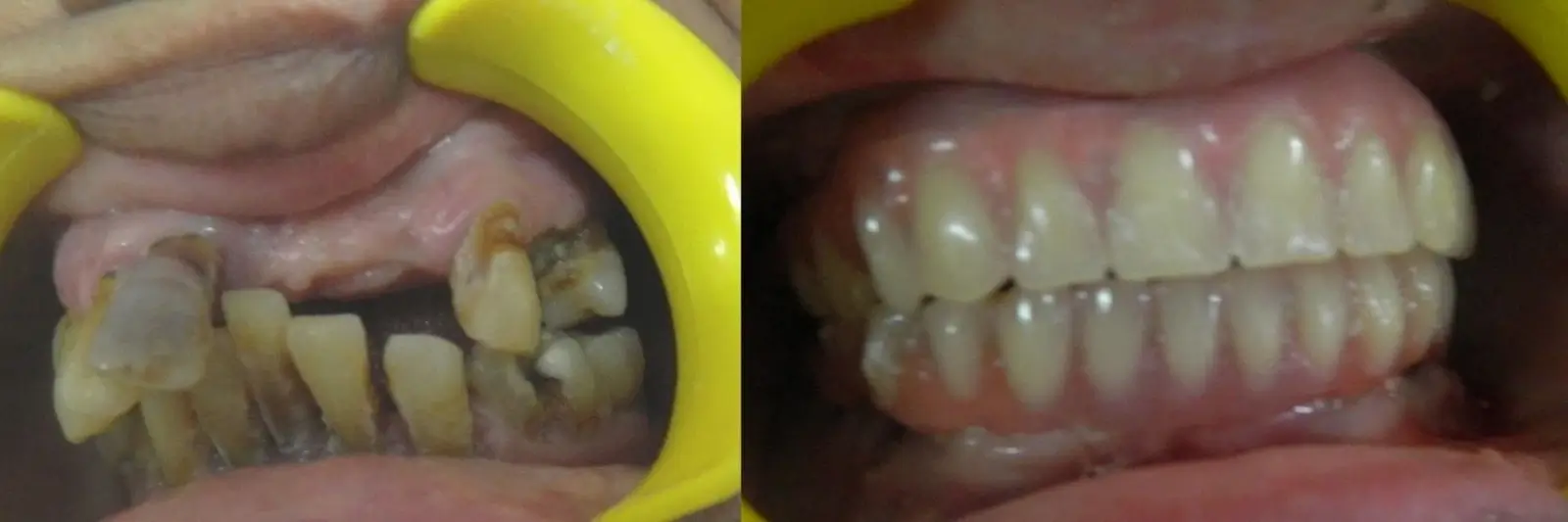 Full mouth immediate basal implants in Sector 40, Gurgaon Immediate basal implants in Sector 40, Gurgaon