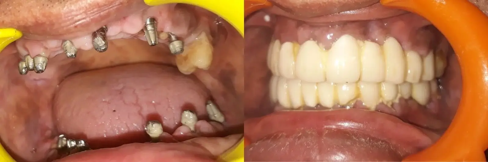 Immediate Full mouth implants in Sector 40, Gurgaon Immediate Full Mouth Implants in Sector 40, Gurgaon