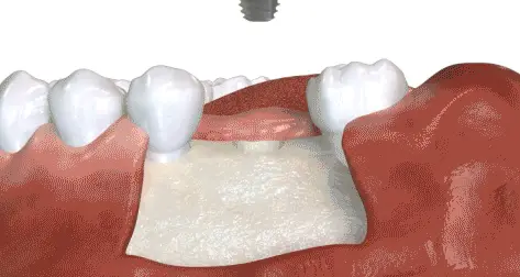 best dental implants in Sector 40, Gurgaon