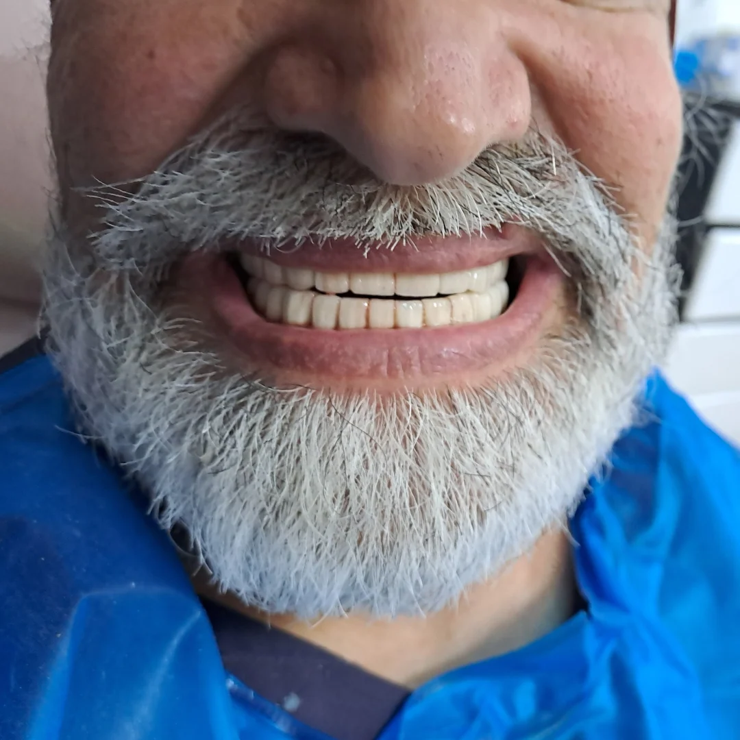 Full mouth dental implant patient from London at i-Smile Gurgaon
