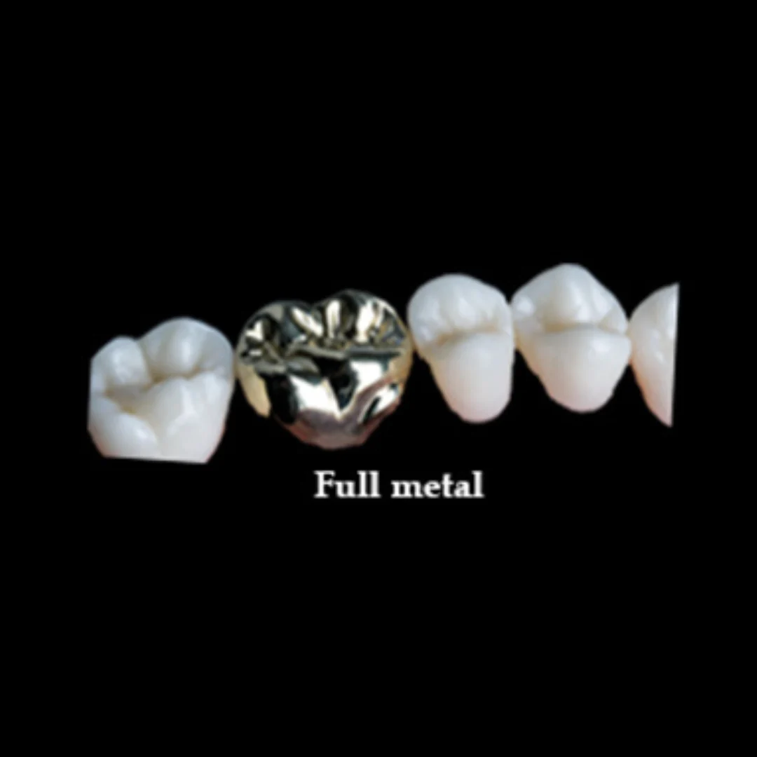 high quality metal crowns in Gurgaon at i-Smile