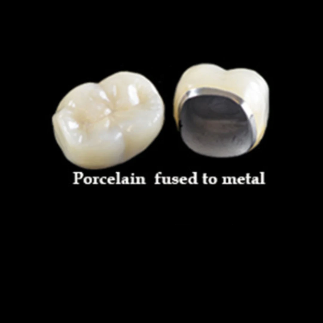 Best porcelain fused to metal PFM crowns and bridges in Gurgaon at i-Smile.