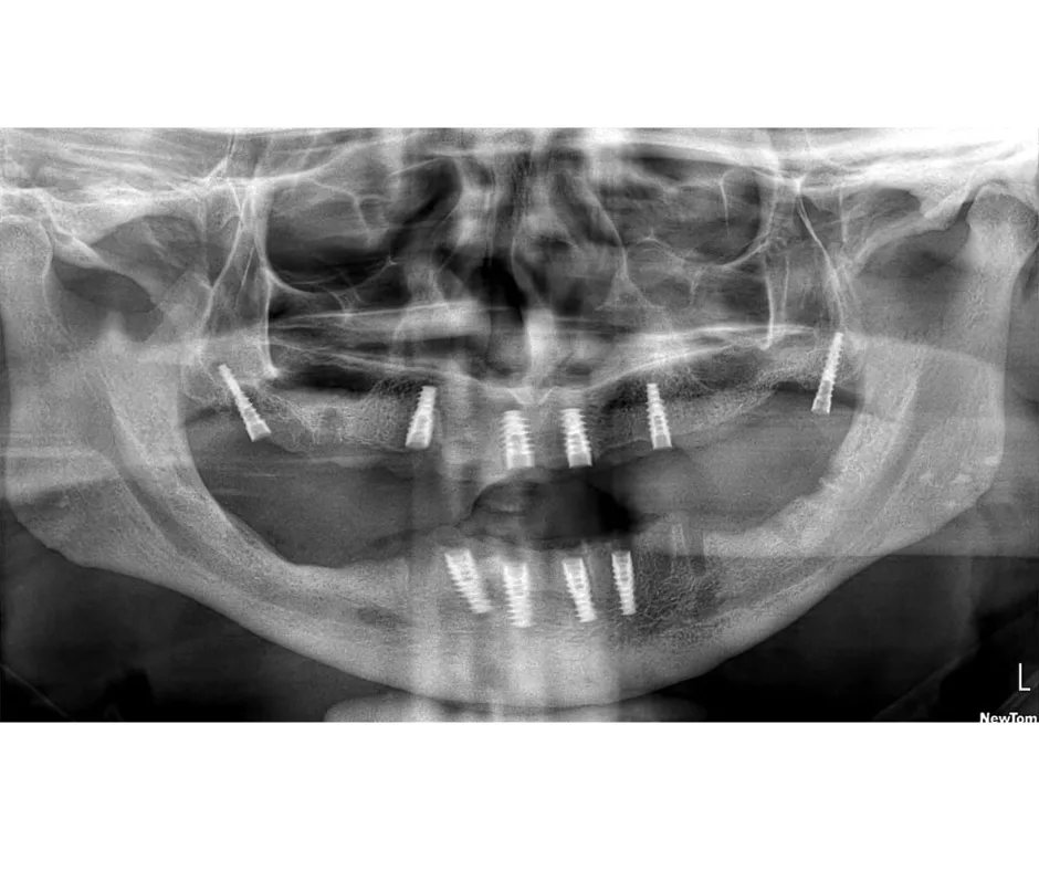 Jasbir, a patient from London, got full mouth dental implants in Gurgaon