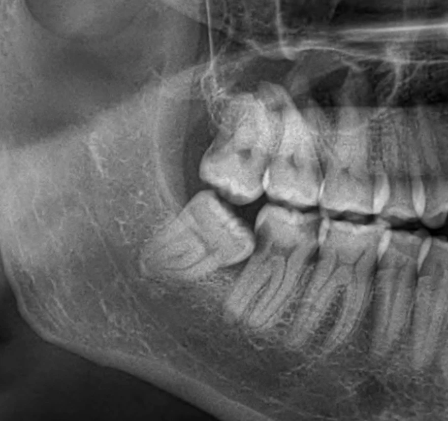 wisdom tooth surgery in Gurgaon wisdom tooth removal in Gurgaon