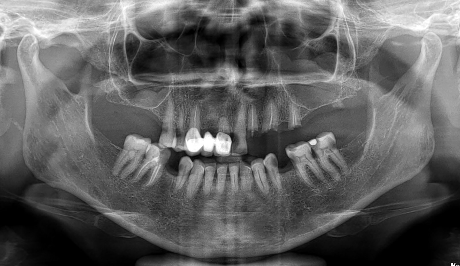 Pre-operative-upper-implant pre-operative-full-upper-arch-implant-case