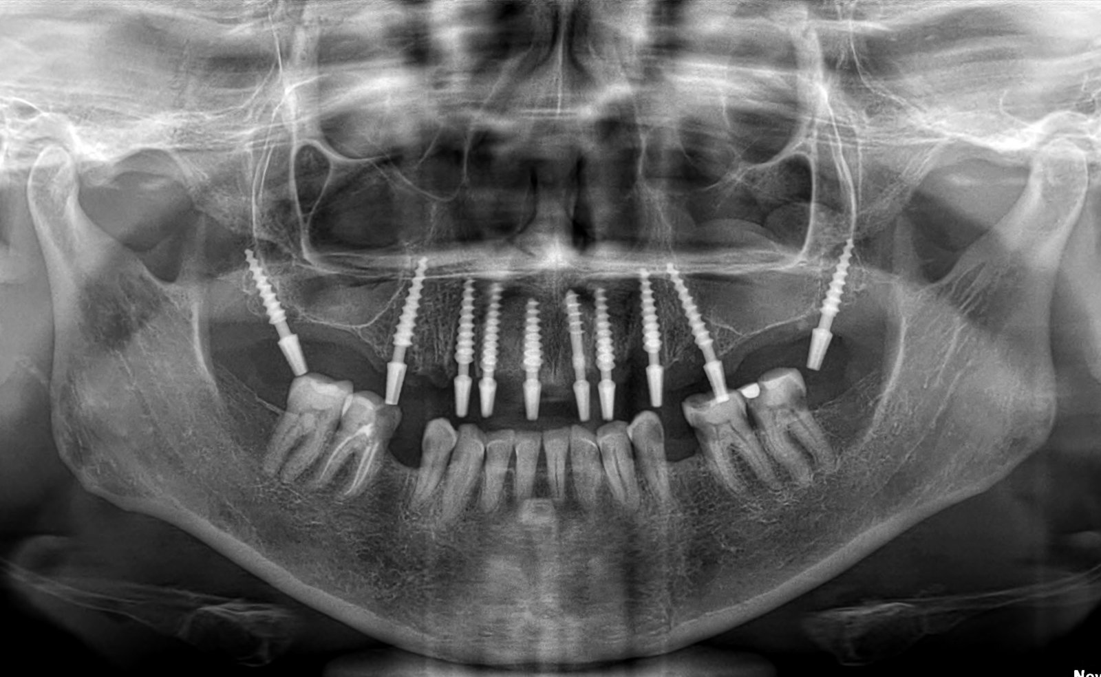 post-operative-upper-implant post-operative-full-arch-implant-case