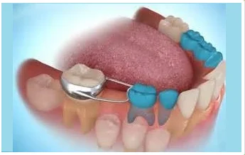 Space maintainer for kid's teeth in Gurgaon
